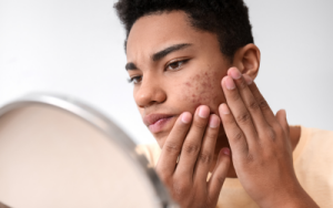 Spots, zits and acne